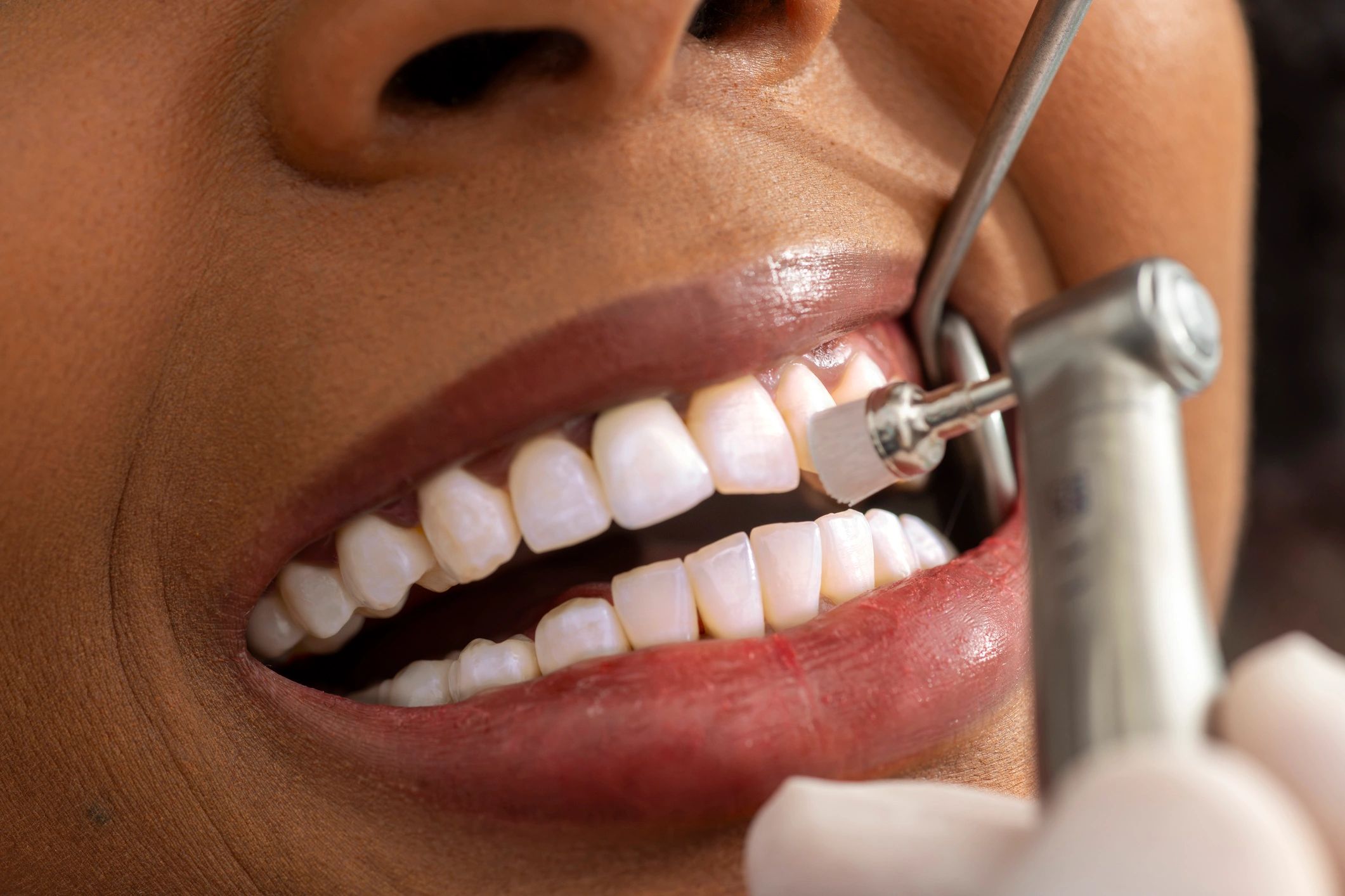 Close-up of a professional dental cleaning in progress